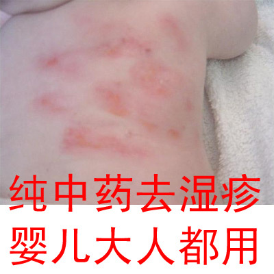 特效中药 适用于 湿疹 顽固湿疹 成人湿疹  婴儿湿疹 尿布疹