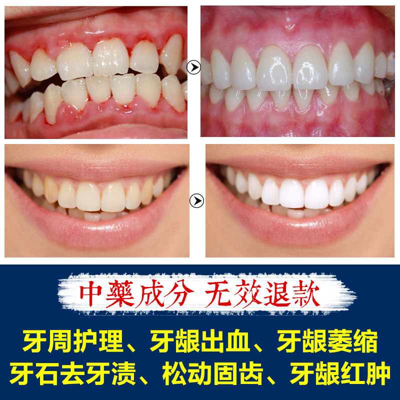 固齿散牙齿松动萎缩牙龈出血牙周牙龈红肿牙齿美白去牙渍洗牙粉